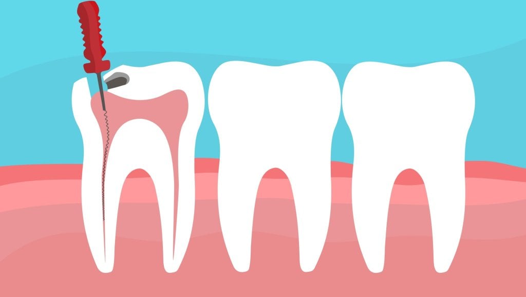 root canal metairie dentist