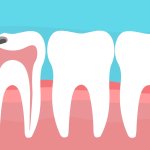 root canal metairie dentist